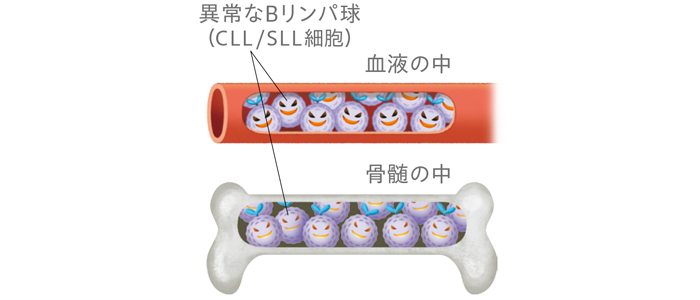 慢性リンパ性白血病（CLL）