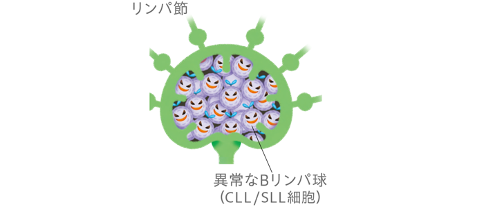 小リンパ球性リンパ腫（SLL）