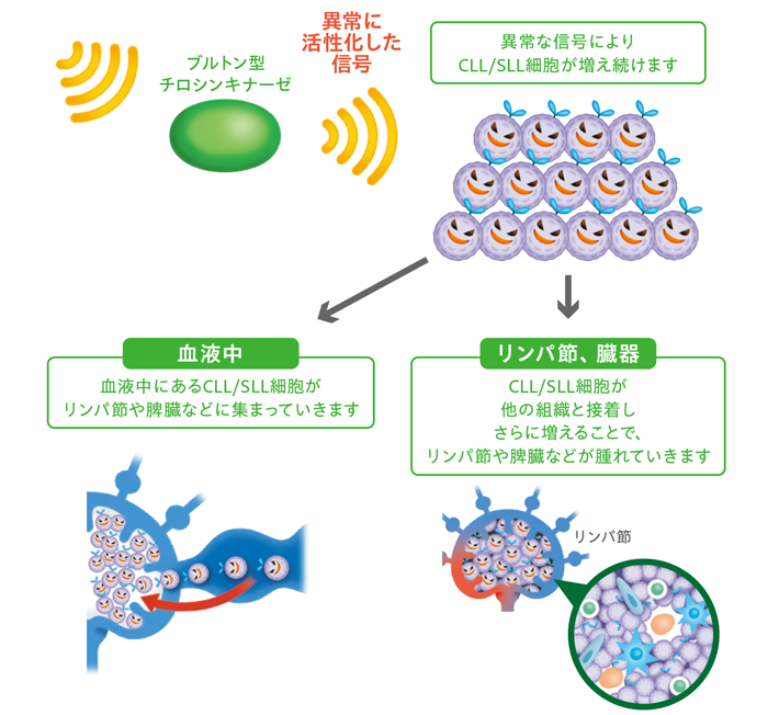 イムブルビカ®投与前のCLL/SLL細胞