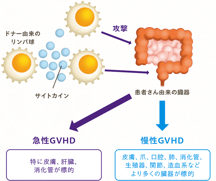 移植片対宿主病（GVHD）について