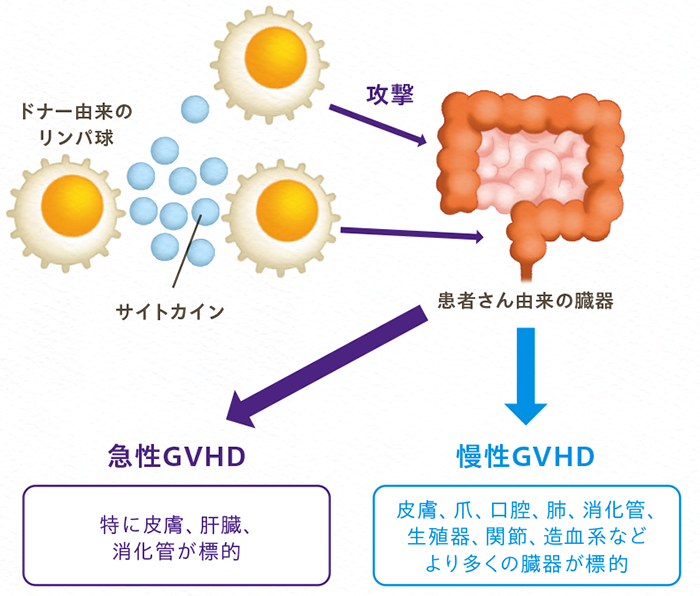 移植片対宿主病（GVHD）